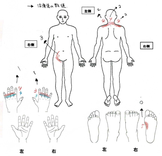 全身の痛み（体のあちこちが痛い）・痛覚変調性疼痛｜小泉医院遠絡医療