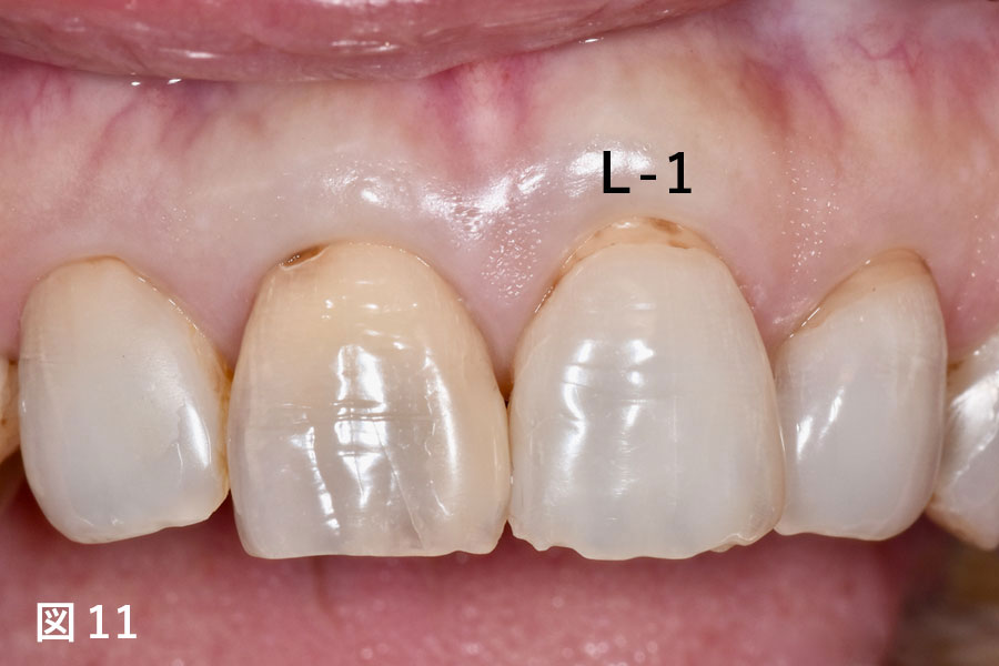 上顎前歯4本をセラミックスで治療した審美症例 | 高坂デンタルオフィス
