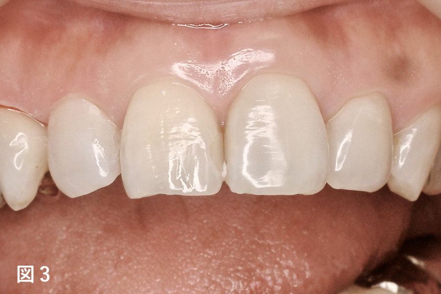 上顎前歯4本をセラミックスで治療した審美症例 | 高坂デンタルオフィス