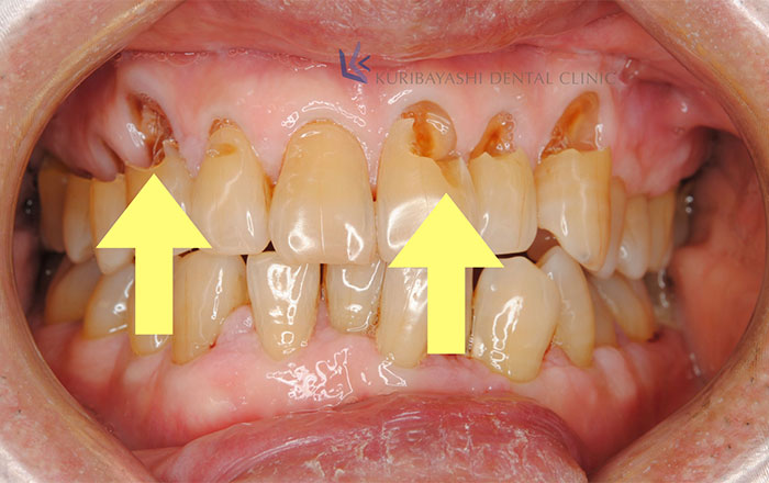 Q.歯がボロボロになる前に予防する方法は？ | 新浦安の歯医者・歯科