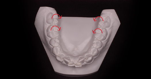 MOOテクニックを使った非抜歯治療について | 神戸市 東灘区の歯列矯正