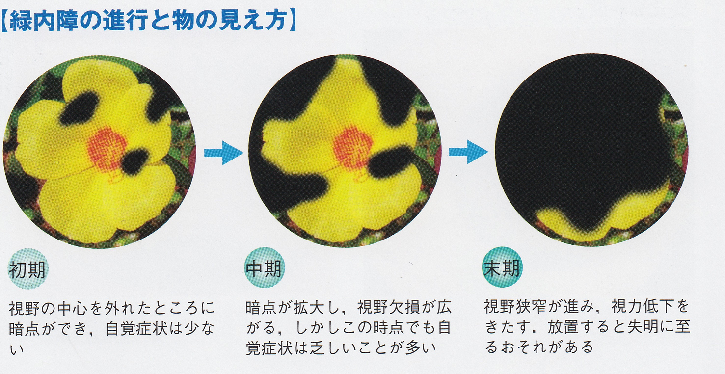 原発開放隅角緑内障 (よくある目の病気 86) ｜ 京橋クリニック眼科