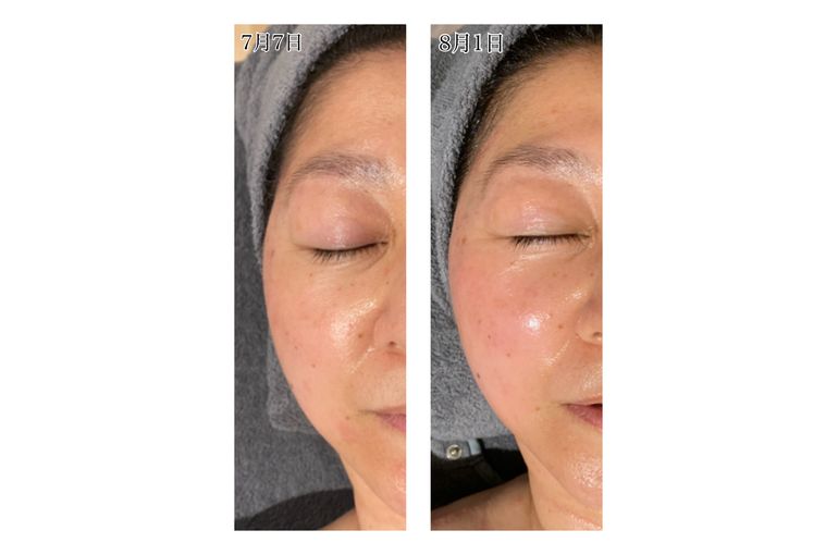 大阪 フェイシャルエステ】グランスキン リアボーテ インフィニット の効果