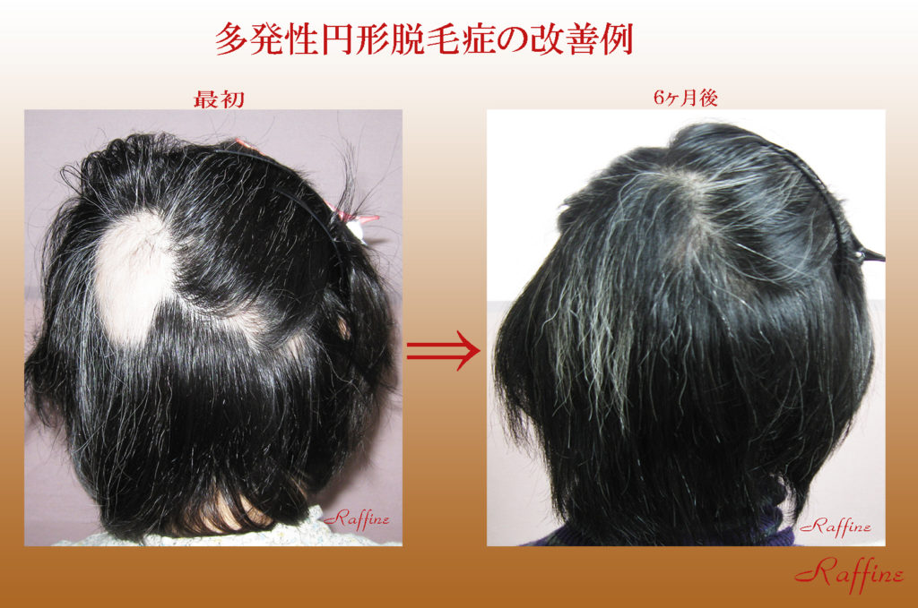 繰り返す円形脱毛症、治療後悪化からの改善！発毛も白髪から黒髪に