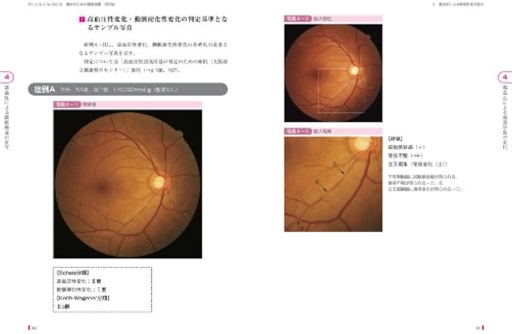 健診のための眼底検査 改訂版〜無散瞳カメラによる撮影と判定〜 (手に