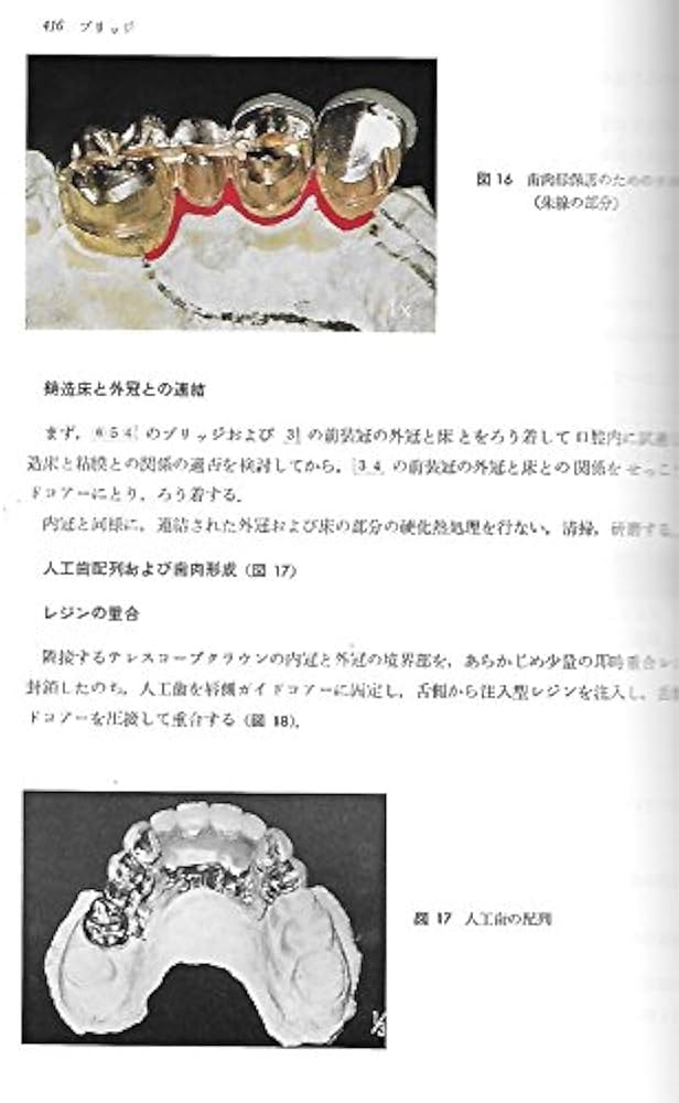 クラウン・ブリッジの臨床 (1972年) | 多和田 泰一 |本 | 通販 | Amazon