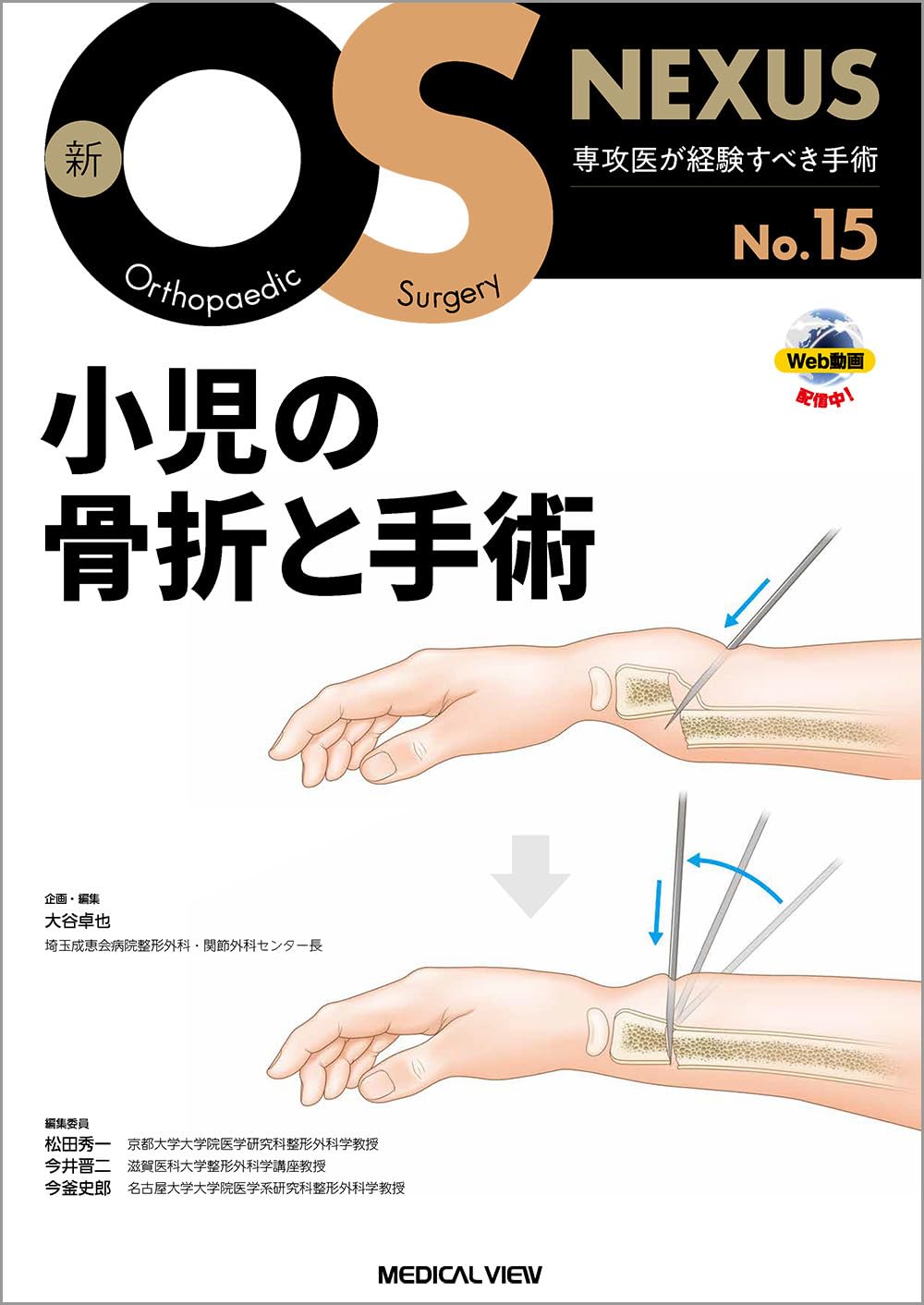 小児の骨折と手術［Web動画付］ (新OS NEXUS) | 大谷 卓也 |本 | 通販