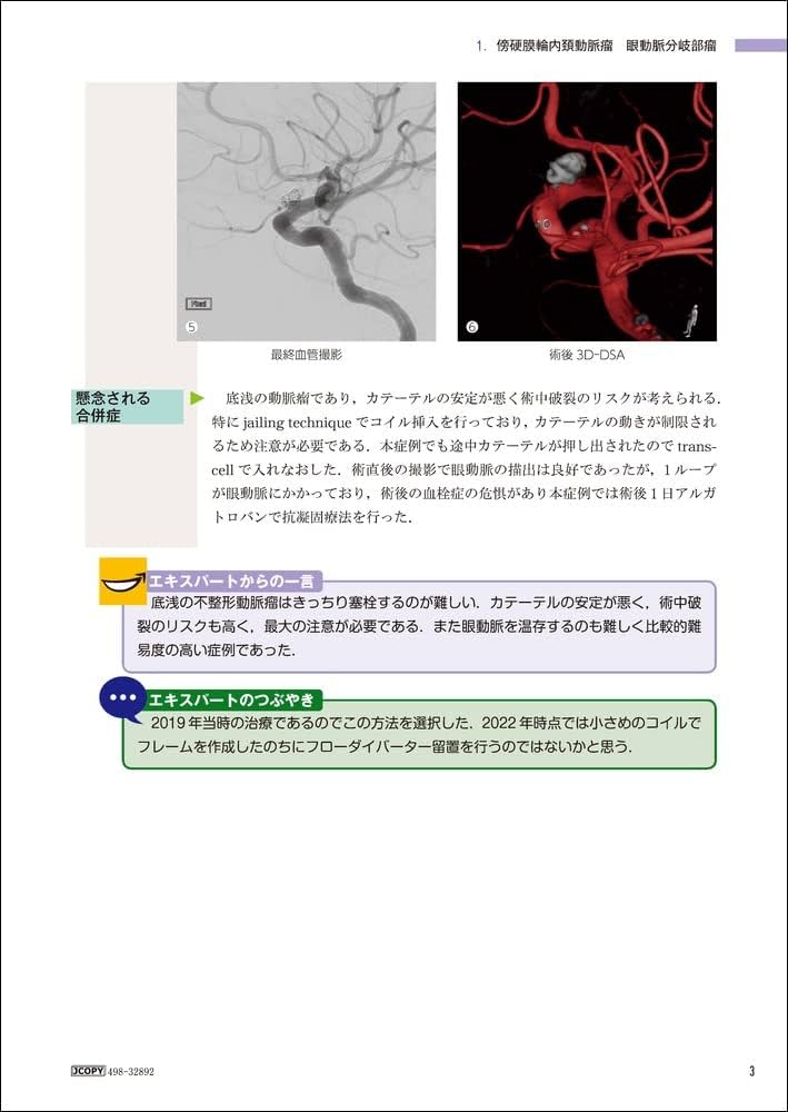 未破裂脳動脈瘤コイル塞栓術100のテクニック | 大石 英則 |本 | 通販