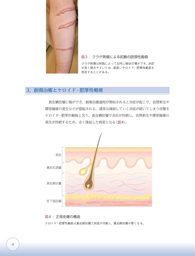ここまでできる ケロイド・肥厚性瘢痕の予防と治療【電子版付】 | 小川