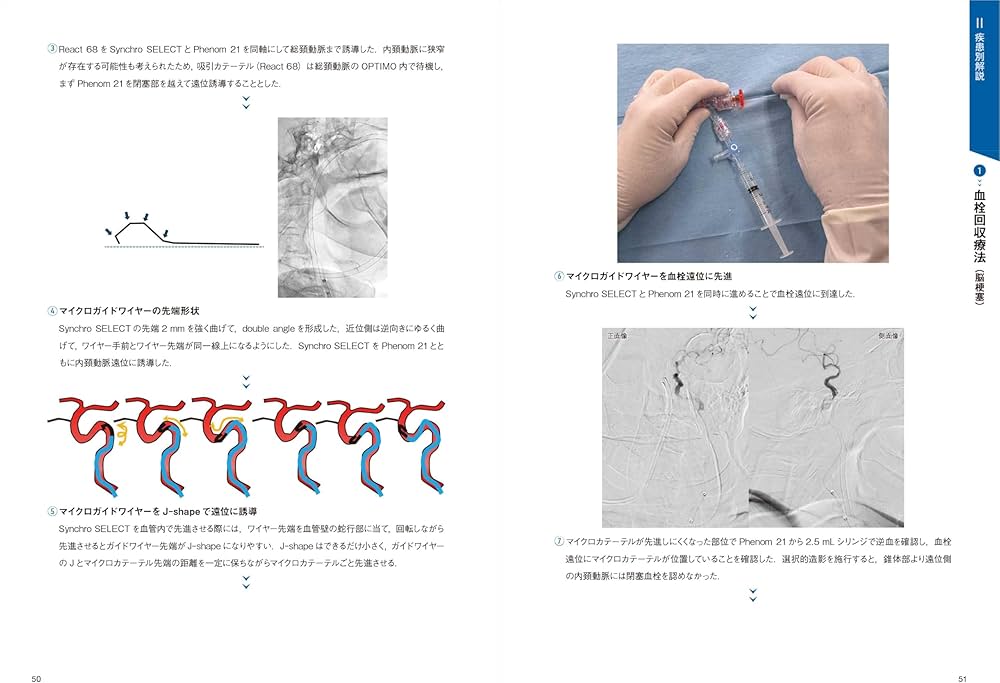 脳血管内治療の基本テクニック：コマ送り解説で知識と技術が結びつく