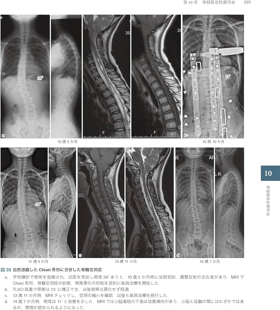 Amazon.co.jp: 症例から学ぶ小児脊柱変形（基礎から難治性疾患まで