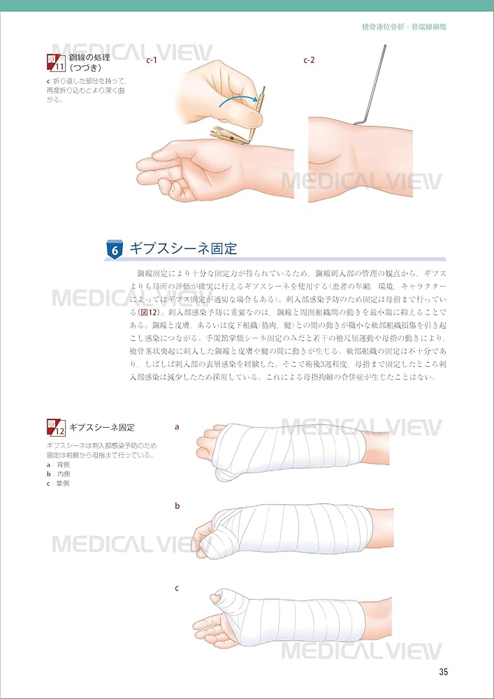 小児の骨折と手術［Web動画付］ (新OS NEXUS) | 大谷 卓也 |本 | 通販