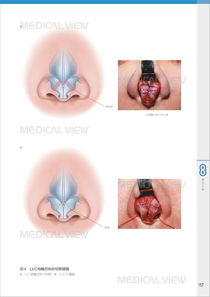Amazon.co.jp: 外鼻形成術−機能と形態を両立した手術 : ライノプラス