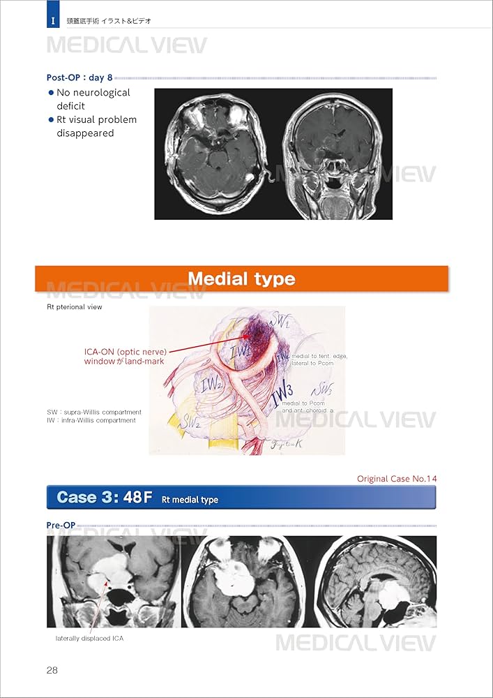 エッセンシャル頭蓋底外科−イラストとビデオで学ぶ頭蓋底中心部腫瘍の