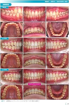 GPがアライナー矯正を行うときに外せないポイントをやさしく症例に沿っ