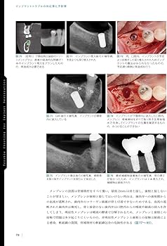 インプラントトラブルの対応策と予防策 | 鈴木 貴規 |本 | 通販 | Amazon