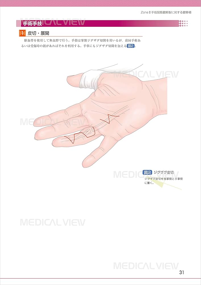 Amazon.co.jp: 手・手関節の骨折・外傷の手術 (OS NEXUS(電子版付き) 3