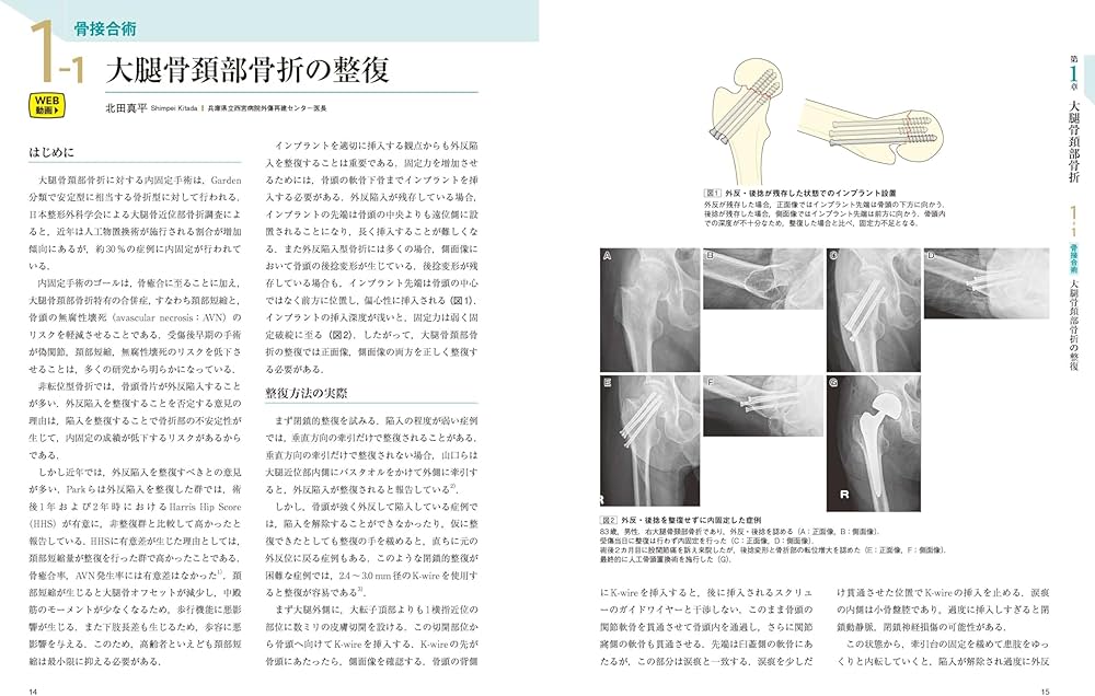 大腿骨近位部骨折：大腿骨頚部・転子部・転子下骨折の手術手技 (整形