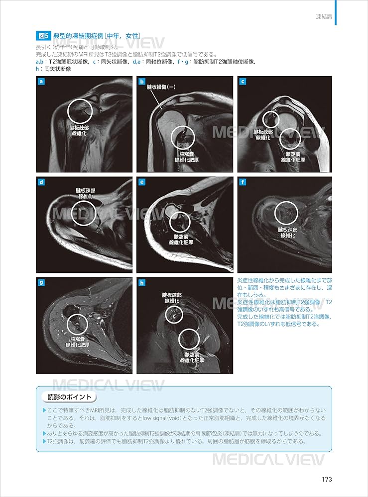 肩関節のMRI−読影ポイントと新しい知見−第3版 | 佐志 隆士, 秋田