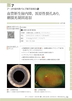 緑内障ロングチューブシャント手術実践マニュアル | 谷戸 正樹 |本