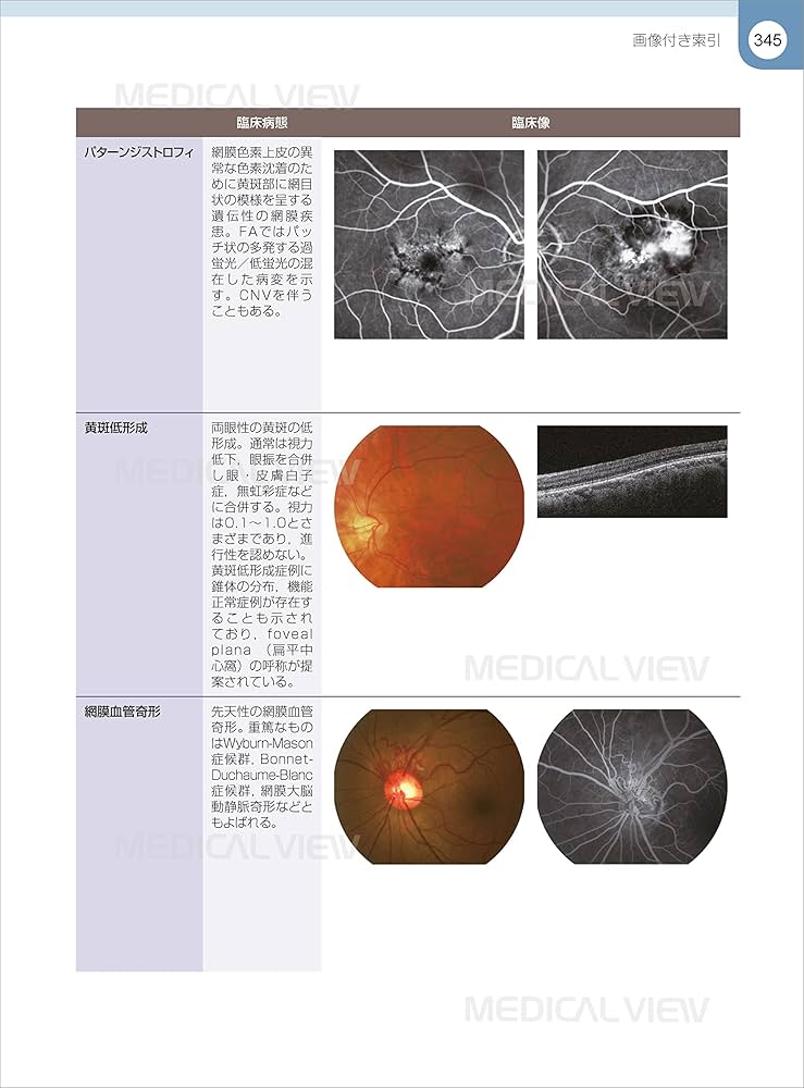 網膜診療クローズアップ 改訂第2版 | 柳 靖雄 |本 | 通販 | Amazon