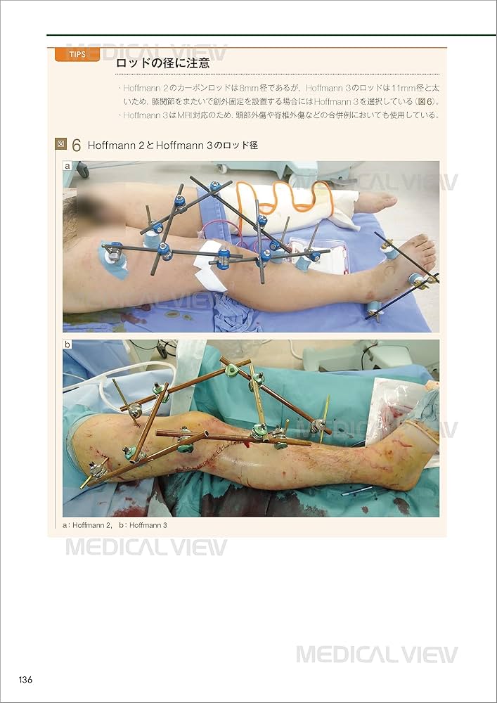 Amazon.co.jp: 一時的創外固定マニュアル : 日本四肢再建・創外固定
