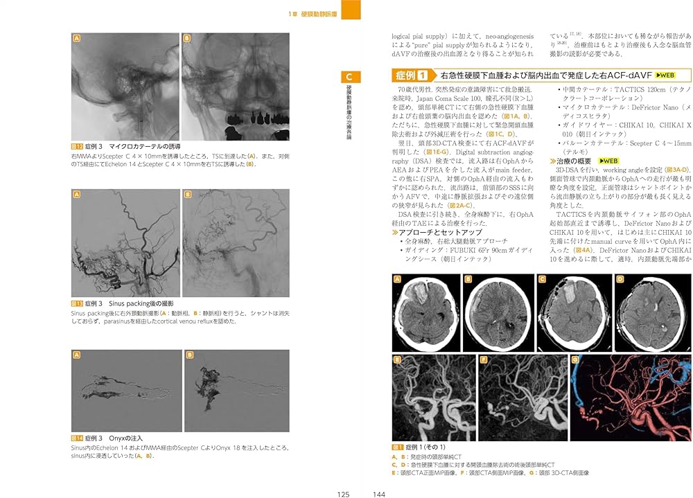 dAVF・AVM（硬膜動静脈瘻・脳動静脈奇形）のすべて：中枢神経系