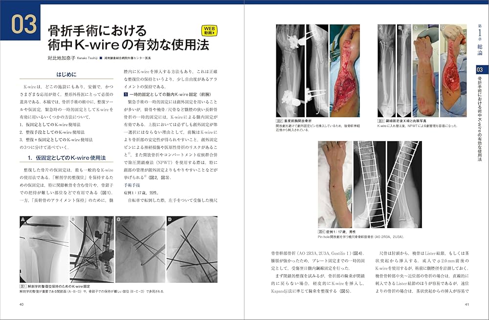 骨折のピンニングと経皮的スクリュー固定： 経皮テクニック完全攻略