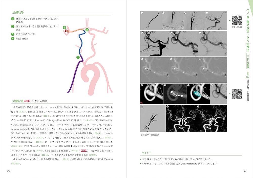 経橈骨動脈脳血管内治療（TRN）超入門：145本のWEB動画とイラストで