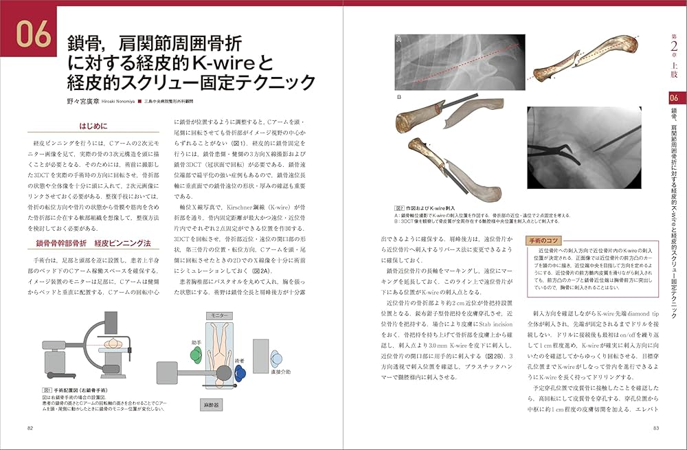 骨折のピンニングと経皮的スクリュー固定： 経皮テクニック完全攻略