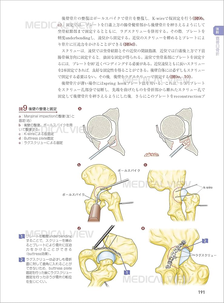 骨折 プレート治療マイスター−改訂第2版 | 澤口 毅 |本 | 通販 | Amazon