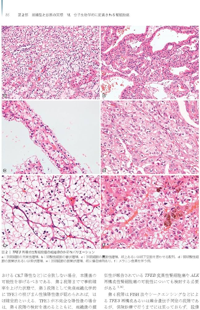 腎癌 第2版(腫瘍病理鑑別診断アトラス) | 大江 知里, 長嶋 洋治 |本