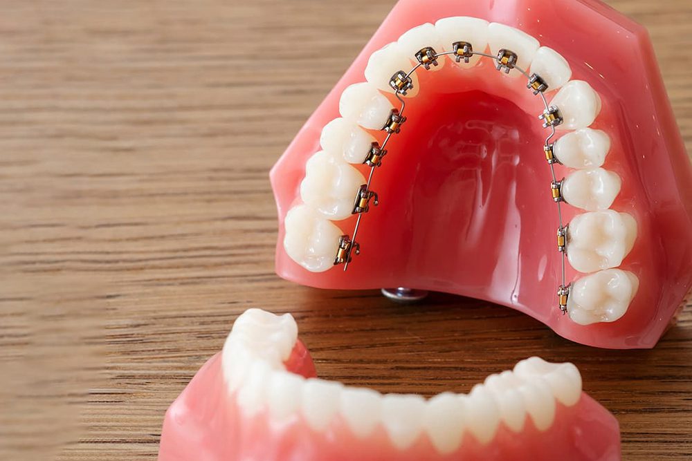 裏側ワイヤー矯正｜町田KT矯正歯科 - 町田駅から徒歩3分の矯正歯科