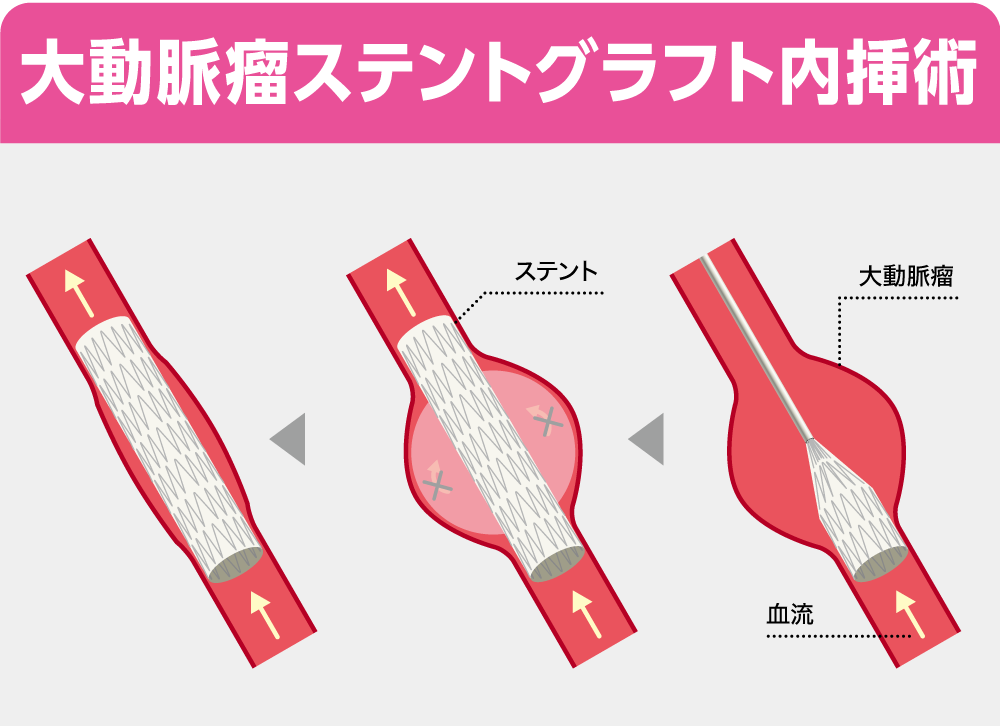 名医を探せ!! 大動脈瘤ステントグラフト内挿術