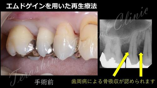 歯周組織再生療法～エムドゲインを用いた症例～ | 箕面市の歯医者