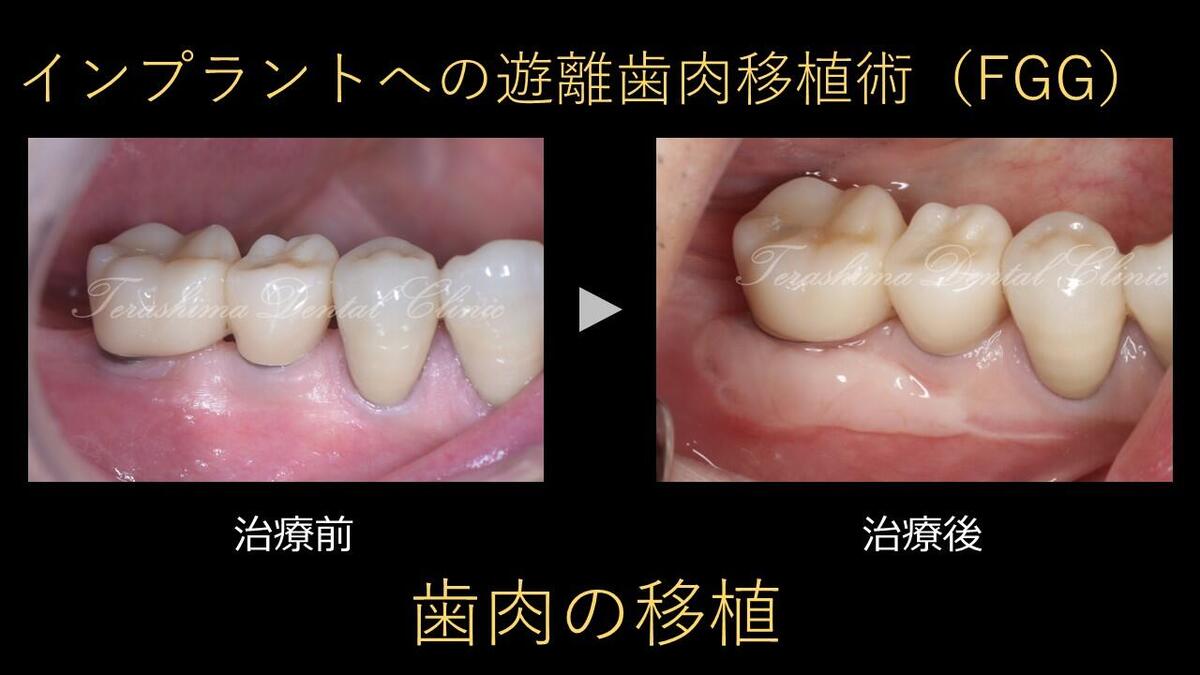 歯肉の移植術~遊離歯肉移植術~インプラント | 箕面市の歯医者【寺嶋