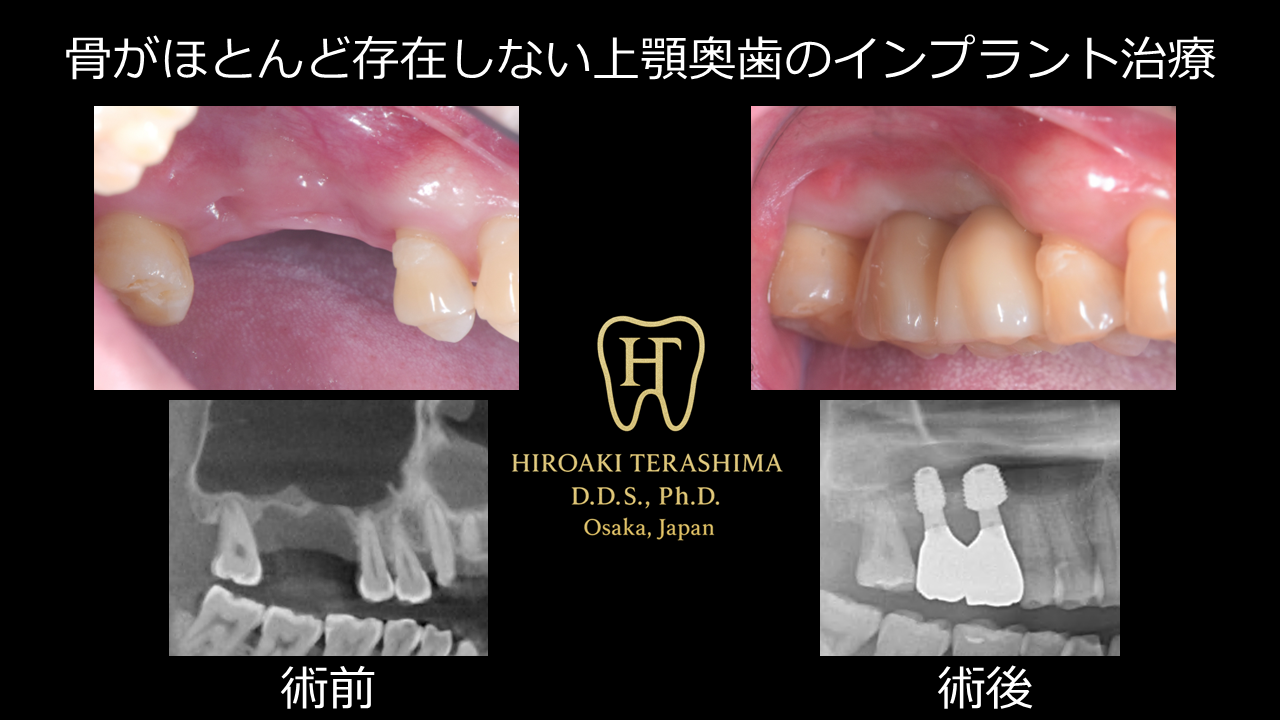 症例集 | 安心のインプラント治療なら寺嶋歯科医院【大阪・箕面】