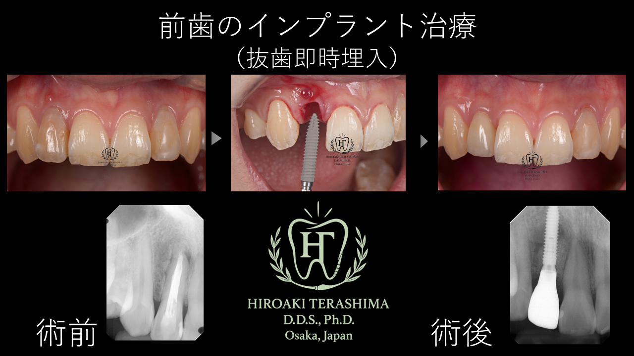 超難症例＞前歯部の歯根破折に対する抜歯即時インプラント症例 | 箕面