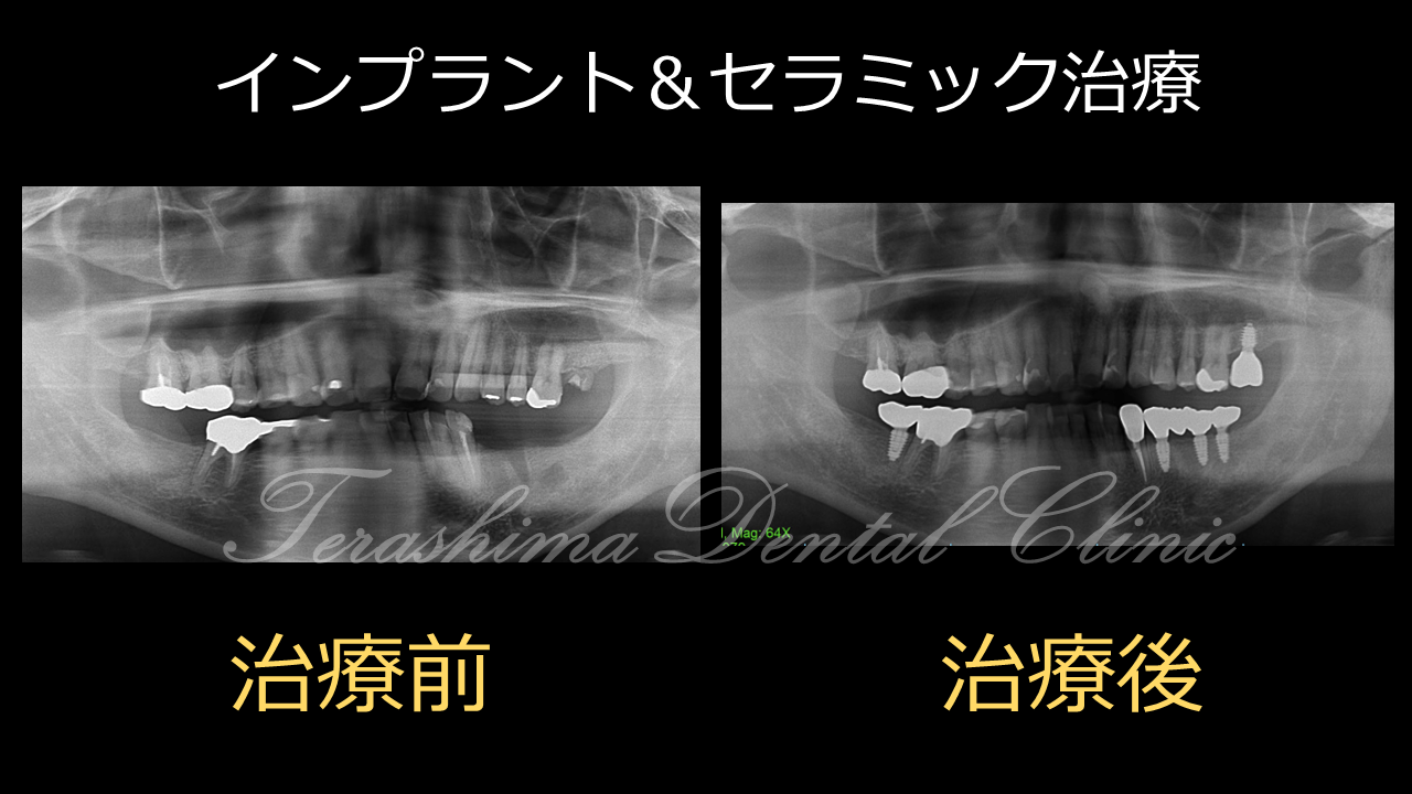シンプルなインプラントとセラミックの複合治療～60代男性～ | 箕面市
