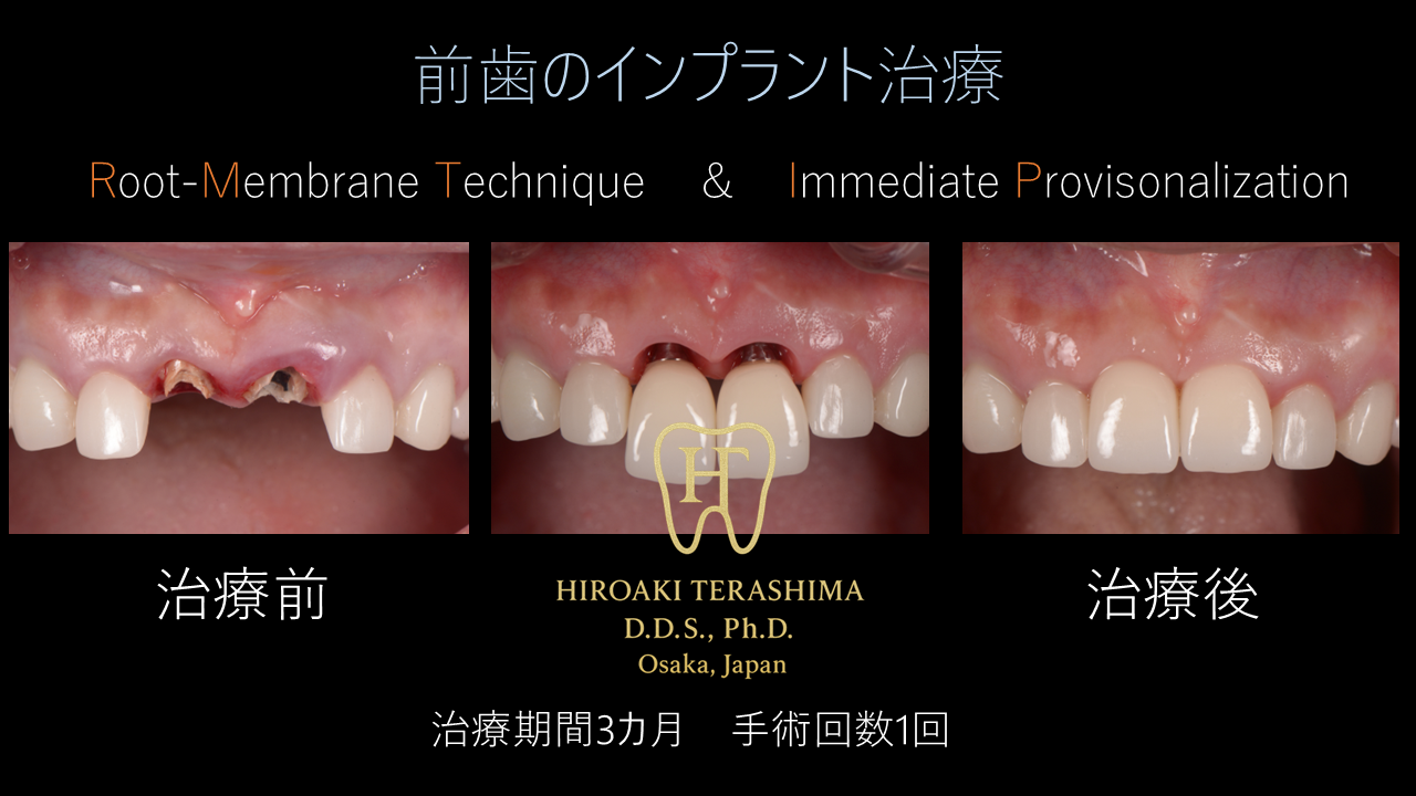 前歯インプラント治療症例 ～ルートメンブレンテクニックで自然な