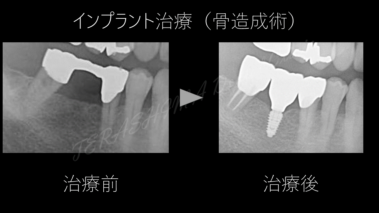 骨造成術（GBR）を使ったインプラント治療～シンプル is ベスト