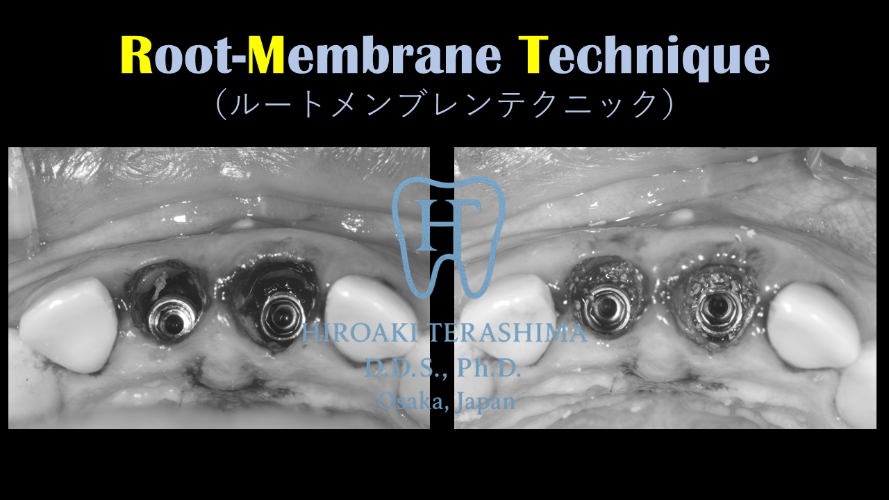 前歯インプラント治療症例 ～ルートメンブレンテクニックで自然な