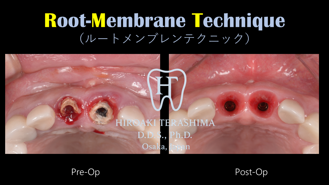 前歯インプラント治療症例 ～ルートメンブレンテクニックで自然な