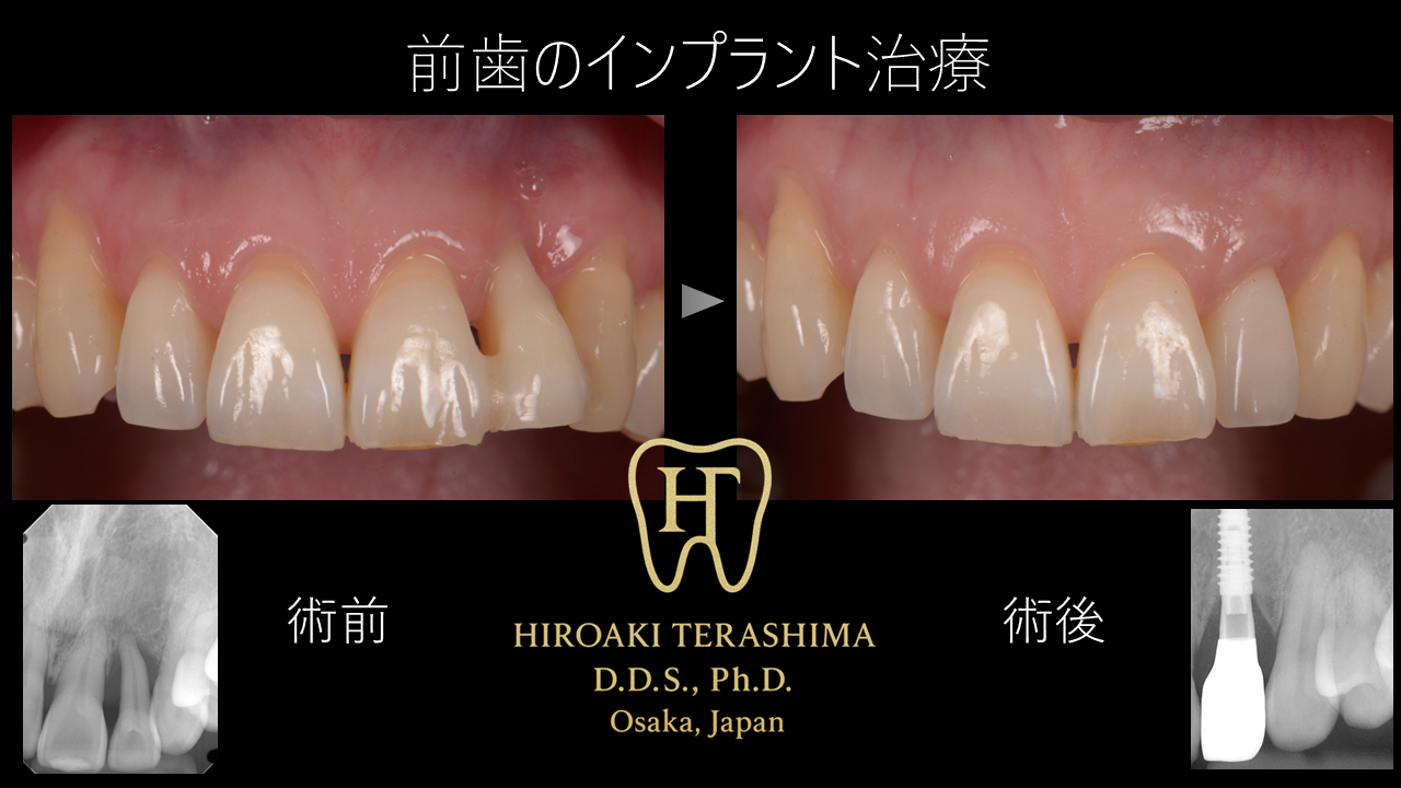 前歯のインプラント治療 〜重度歯周炎による歯肉と骨の喪失