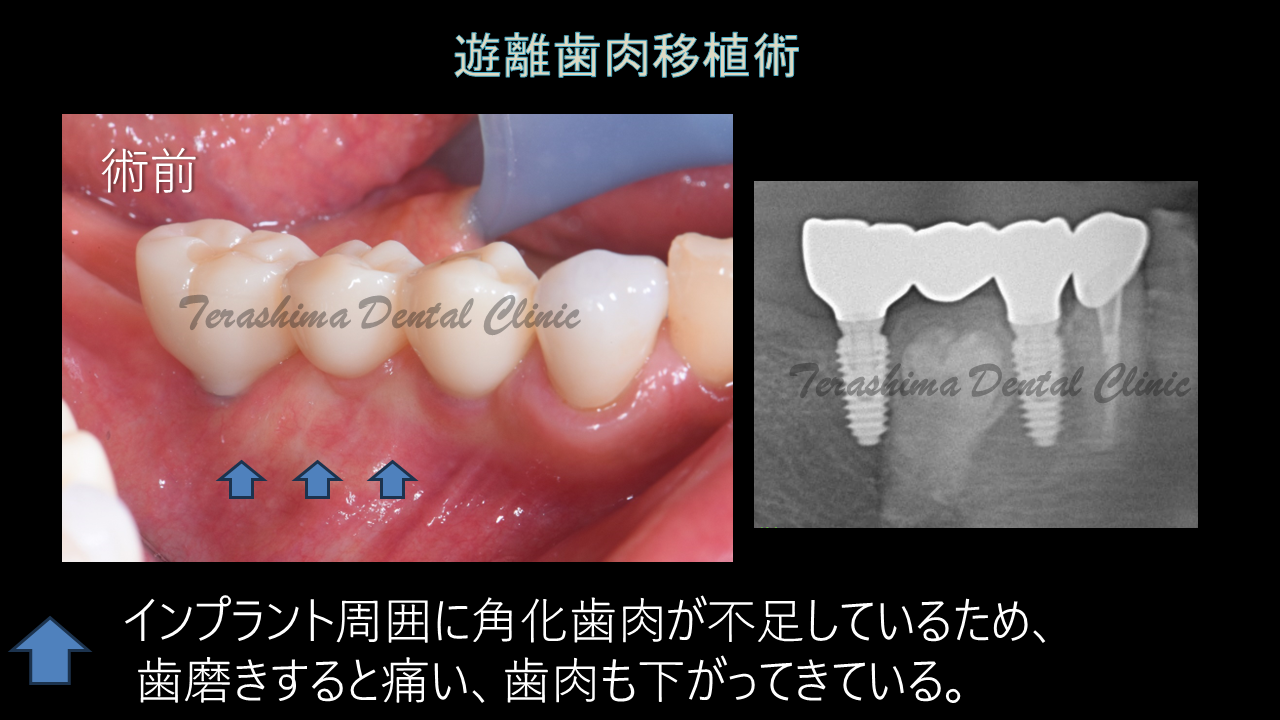 歯肉の移植術~遊離歯肉移植術~インプラント | 箕面市の歯医者【寺嶋