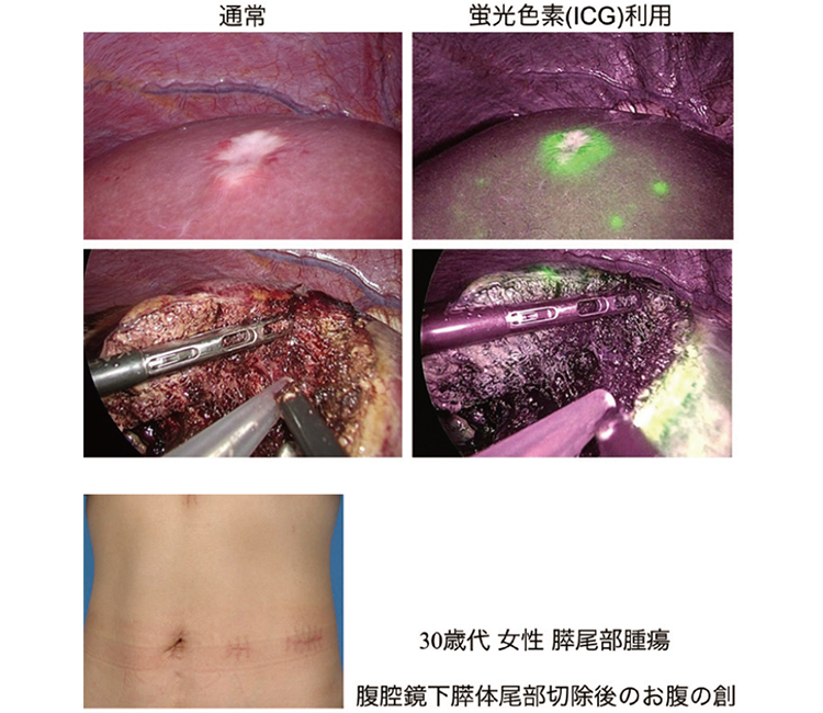 最新の肝臓・胆道・膵臓がん手術 | 病気と治療の検索サイト