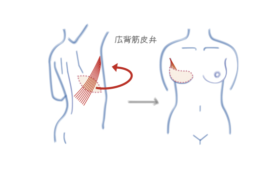 ウエスト3本バンド / メディカル サラマシェリ <脂肪吸引術・乳房再建