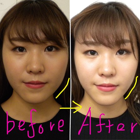 最新の美顔器EMS・痛みなく強力リフトアップ効果！！ – Bilde av Salon