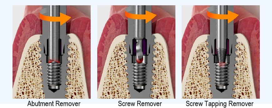MegGyver Kit｜製品情報｜株式会社メガジェンジャパン｜歯科用