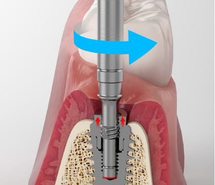 MegGyver Kit｜製品情報｜株式会社メガジェンジャパン｜歯科用